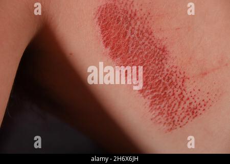 Close up of an abrasion wound in Caucasian skin Stock Photo