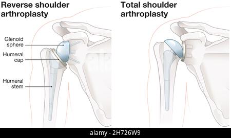 Illustration showing reverse shoulder arthroplasty and total shoulder arthroplasty