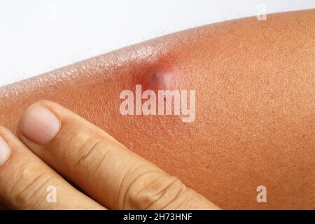 The patient had an abscess on his arm that was scratched by a cat. Stock Photo