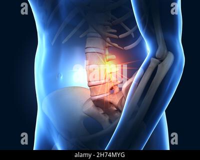 3D illustration showing painful lumbar spine joints, medical 3D illustration Stock Photo