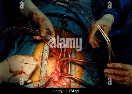 Surgeons during surgery in operation room using all equipment necessary to have a successful surgery Stock Photo