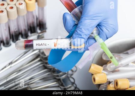 Blood sample for HbA1c test, diabetes diagnosis. Stock Photo