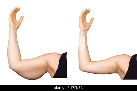 A before and after brachioplasty view on the arm of a Caucasian woman to remove excess skin Stock Photo