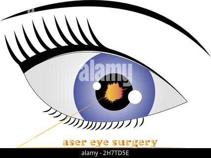 Laser eye surgery logo vector illustration Stock Vector