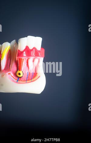 Tooth decay dentists dental model of teeth, gums and root canal Stock Photo