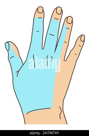 Radial nerve tunnel syndrome. Flat design line drawing of affected area sketch doodle style. Vector illustration Stock Vector