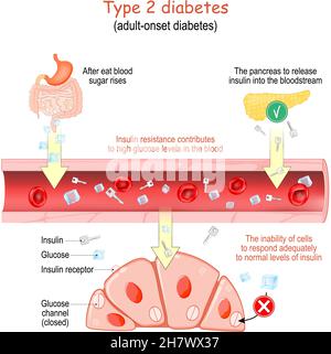 Type 2 diabetes. adult-onset diabetes. Insulin resistance contributes to high glucose levels in the blood. The inability of cells to respond adequatel Stock Vector