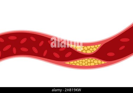 Cholesterol artery thrombosis micro vascular desease. Arteriosclerosis blood vector atherosclerosis risk Stock Vector