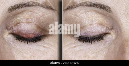 Woman eye before and after stye treatment. Swollen eye on the eyelid ...