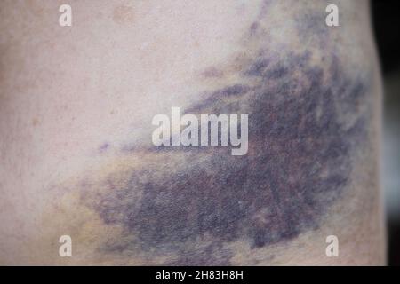 Large bruise on the human body, close up Stock Photo - Alamy