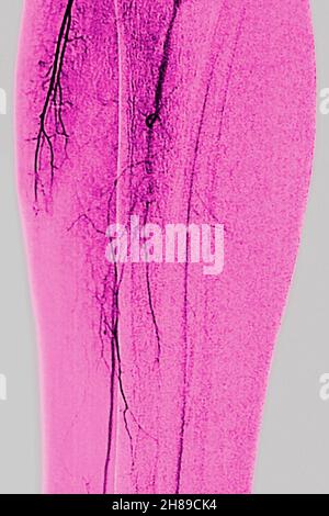 Arteritis of the lower limbs Stock Photo