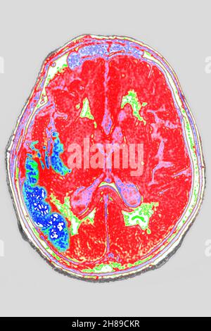 Stroke Stock Photo