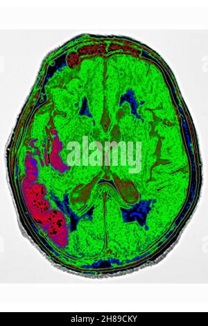 Stroke Stock Photo