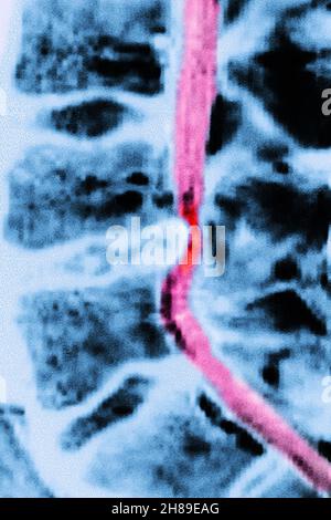 Slipped disc. Magnetic resonance imaging scan of a sagittal section ...
