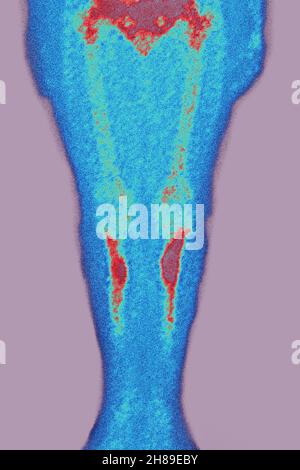 Stress fractures Stock Photo