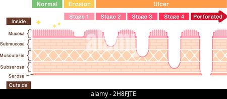 Stages of gastric ulcer ( stomach ulser ) vector illustration Stock Vector