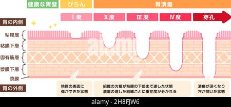 Stages of gastric ulcer ( stomach ulser ) vector illustration Stock Vector