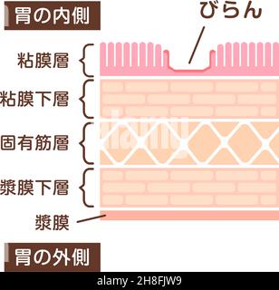 Sectional view illustration  of gastric erosion Stock Vector