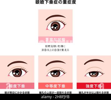 Grading in ptosis vector illustration Stock Vector