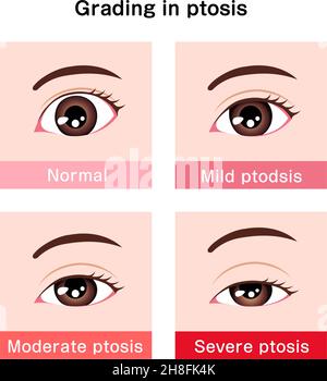 Grading in ptosis vector illustration Stock Vector