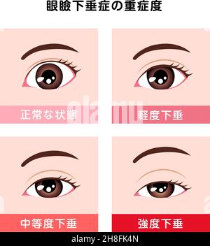 Grading in ptosis vector illustration Stock Vector