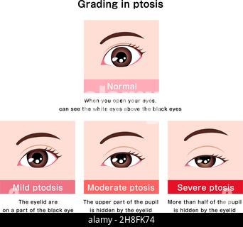 Grading in ptosis vector illustration Stock Vector