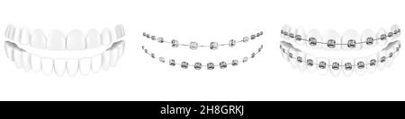 Teeth with or without braces. Arch braces without teeth. Orthodontic ...
