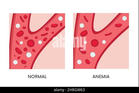 Normal and anemia amount of red blood cells in blood flat illustration. Iron deficiency anemia. Decrease in total amount of erythrocytes or hemoglobin Stock Vector
