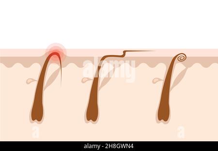 Types of ingrown hairs flat illustration. Cross section of the human skin with hair follicles. Hair removal concept. Shaving, depilation, cosmetology Stock Vector