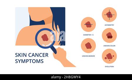 Skin cancer diagnosis. Doctor detecting asymmetric evolving spot on ...