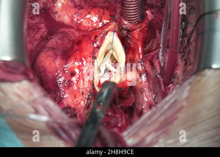 Cardiac surgery close-up. Open heart with connected tubes and surgical tools. Stock Photo