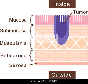 Sectional view illustration of stomach cancer (gastric cancer) Stock Vector
