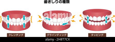 Types of bruxism (teeth grinding) vector illustration Stock Vector