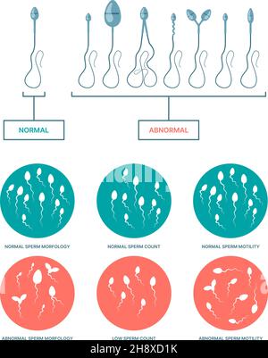 Spermogram. Medical infographic with healthy and damaged spermatozoa birth plan ovulation processes garish vector flat templates Stock Vector
