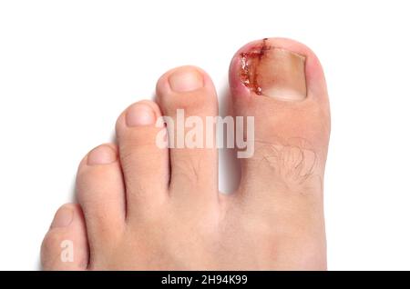 Ingrown toenail onychocryptosis on caucasian big toe Hallux