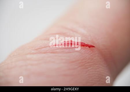 Injured persons finger with bleeding open cut wound Stock Photo