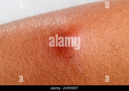 The patient had an abscess on his arm that was scratched by a cat. Stock Photo