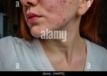 Problem skin. Red eruptions on the girl's face. Stock Photo