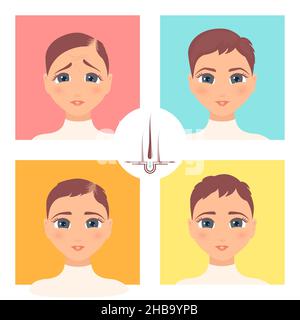 Hair transplantation surgery result in women, illustration. Stock Photo