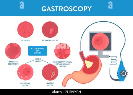 Gastroscopy, conceptual illustration. Gastroscopy is a procedure used to look at the oesophagus, stomach and the duodenum. It can be used to detect diseases, for example from left to right: stomach cancer, gastroesophageal reflux disease (GERD), gastric ulcer, duodenal ulcer, barrett's esophagus and gastritis. Stock Photo