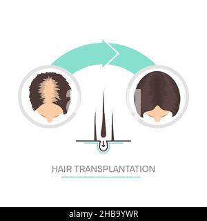 Hair transplantation in women, conceptual illustration. Stock Photo