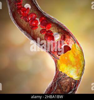 Atherosclerosis. Illustration showing fatty plaque (atheroma, yellow ...