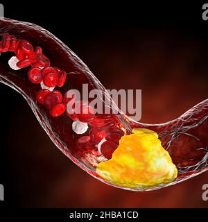 Atherosclerosis. Illustration showing fatty plaque (atheroma, yellow ...