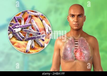 Illustration of a secondary tuberculosis infection and a close-up view of Mycobacterium tuberculosis bacteria, the causative agent of tuberculosis. There is a small-sized solid nodular mass located in the upper lobe of the right lung near its lung apex. Stock Photo