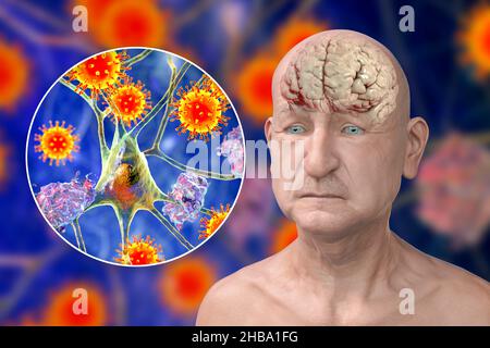 Infectious aetiology of dementia. Conceptual computer illustration showing an elderly person with Alzheimer's disease, progressive impairments of brain functions, amyloid plaques in the brain, and viruses attacking neurons.