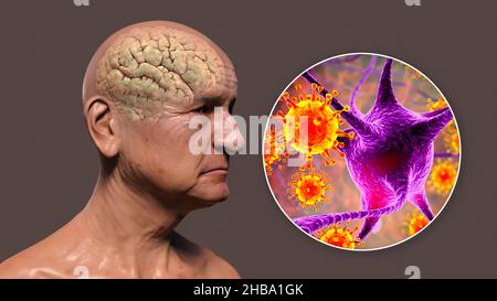 Infectious aetiology of dementia. Conceptual computer illustration showing an elderly person with progressive impairments of brain functions and viruses attacking neurons.