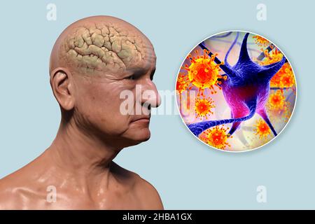 Infectious aetiology of dementia. Conceptual computer illustration showing an elderly person with progressive impairments of brain functions, amyloid plaques in the brain, and viruses attacking neurons.