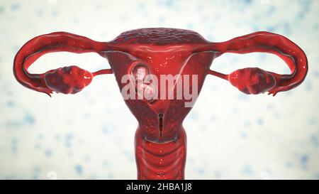 Multiple pregnancy, illustration. Monozygotic twins in the uterus sharing the same placenta at week 8. Stock Photo