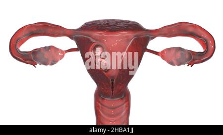 Multiple pregnancy, illustration. Monozygotic twins in the uterus sharing the same placenta at week 8. Stock Photo