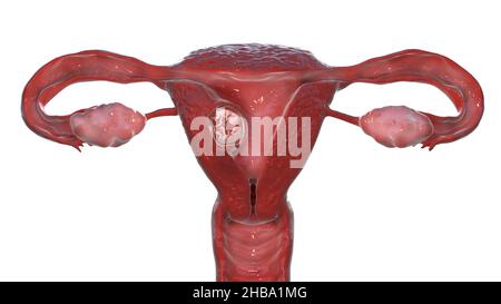 Multiple pregnancy, illustration. Monozygotic twins in the uterus sharing the same placenta. This is the early foetal period between week 8 and week 16. Stock Photo